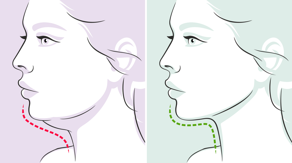 How to Get Rid of Double Chin in a Week